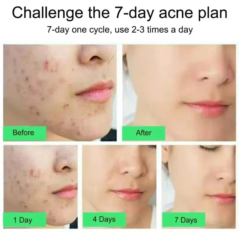 Salicylic Acid Acne Cream – Spot Repair, Oil Control & Pore Care