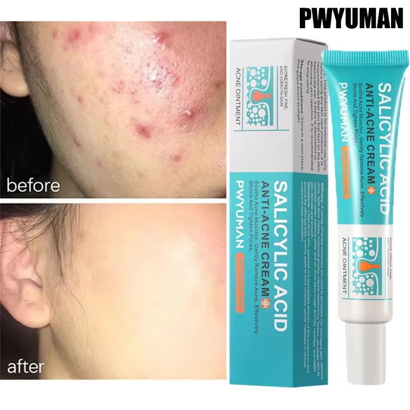 Salicylic Acid Acne Cream – Spot Repair, Oil Control & Pore Care