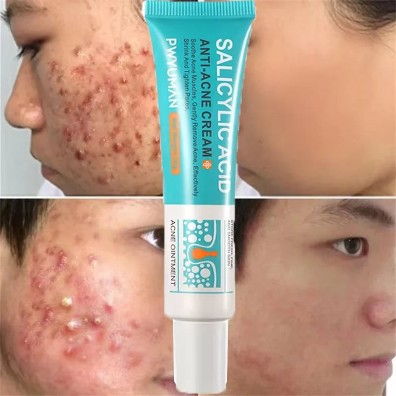 Salicylic Acid Acne Cream – Spot Repair, Oil Control & Pore Care